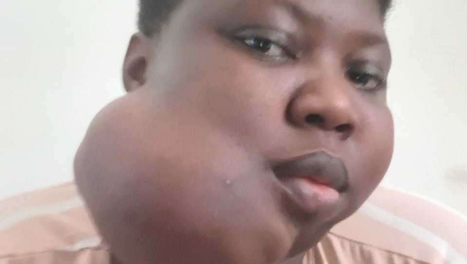 Help Joyce access urgent surgery for a severe jaw tumour
